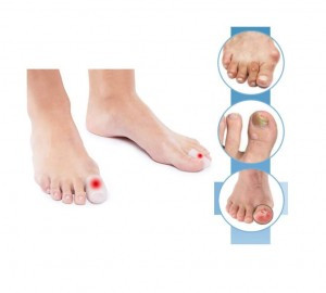 Stopy z odciskami, odcisk na dużym palcu, odcisk na palcu wskazującym i odcisk na małym palcu.